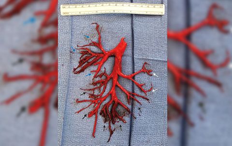 Un coágulo de sangre con una forma perfecta de estructura pulmonar