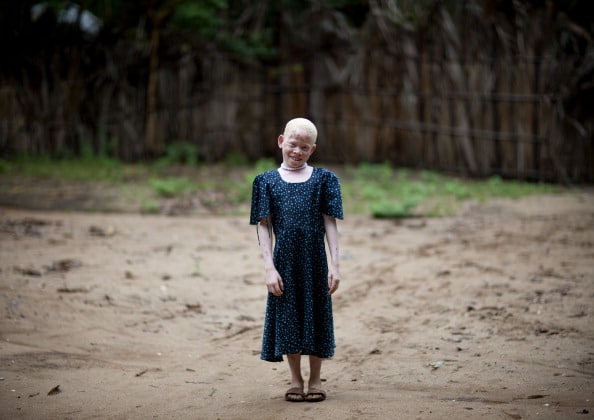 Así viven los albinos en África