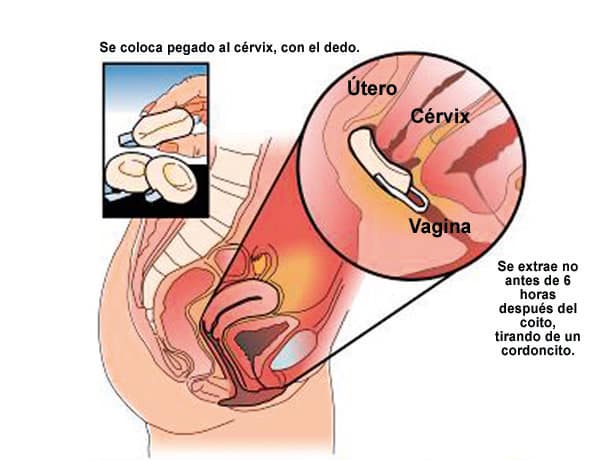 ¿Cómo evita el embarazo la esponja vaginal?