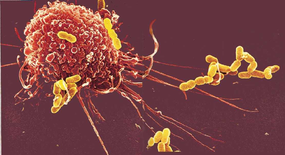 Cómo transformar células de leucemia en otras inmunes