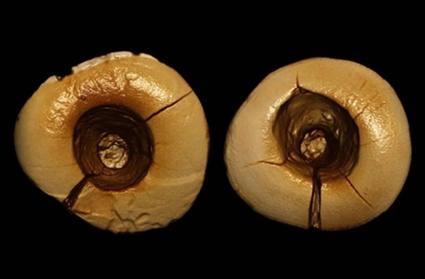 Descubren empastes dentales de la Edad de Hielo