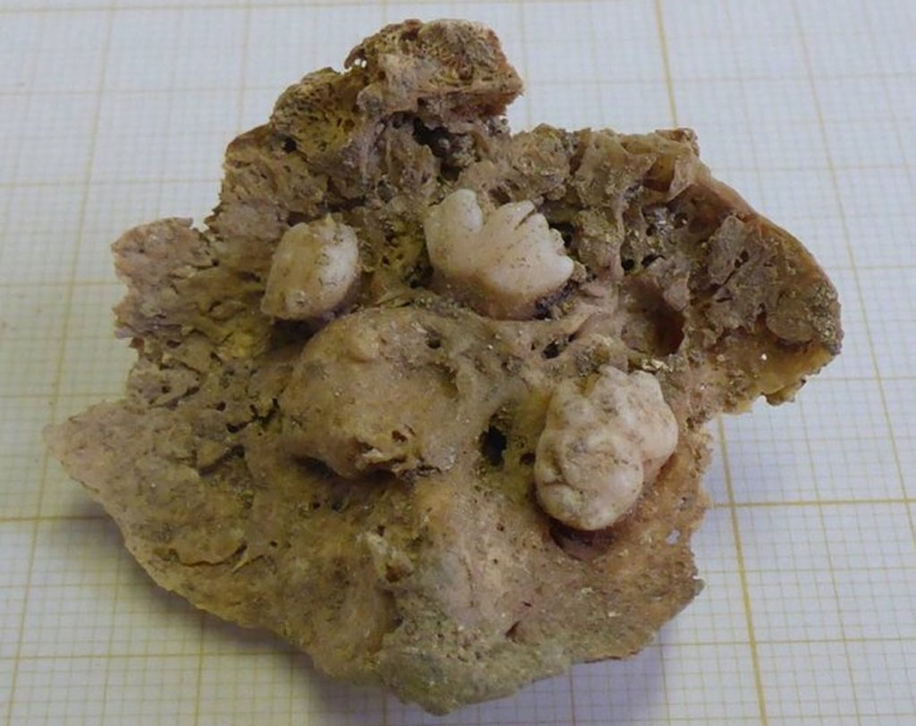 Descubren un tumor con dientes en los ovarios de una momia del siglo XV
