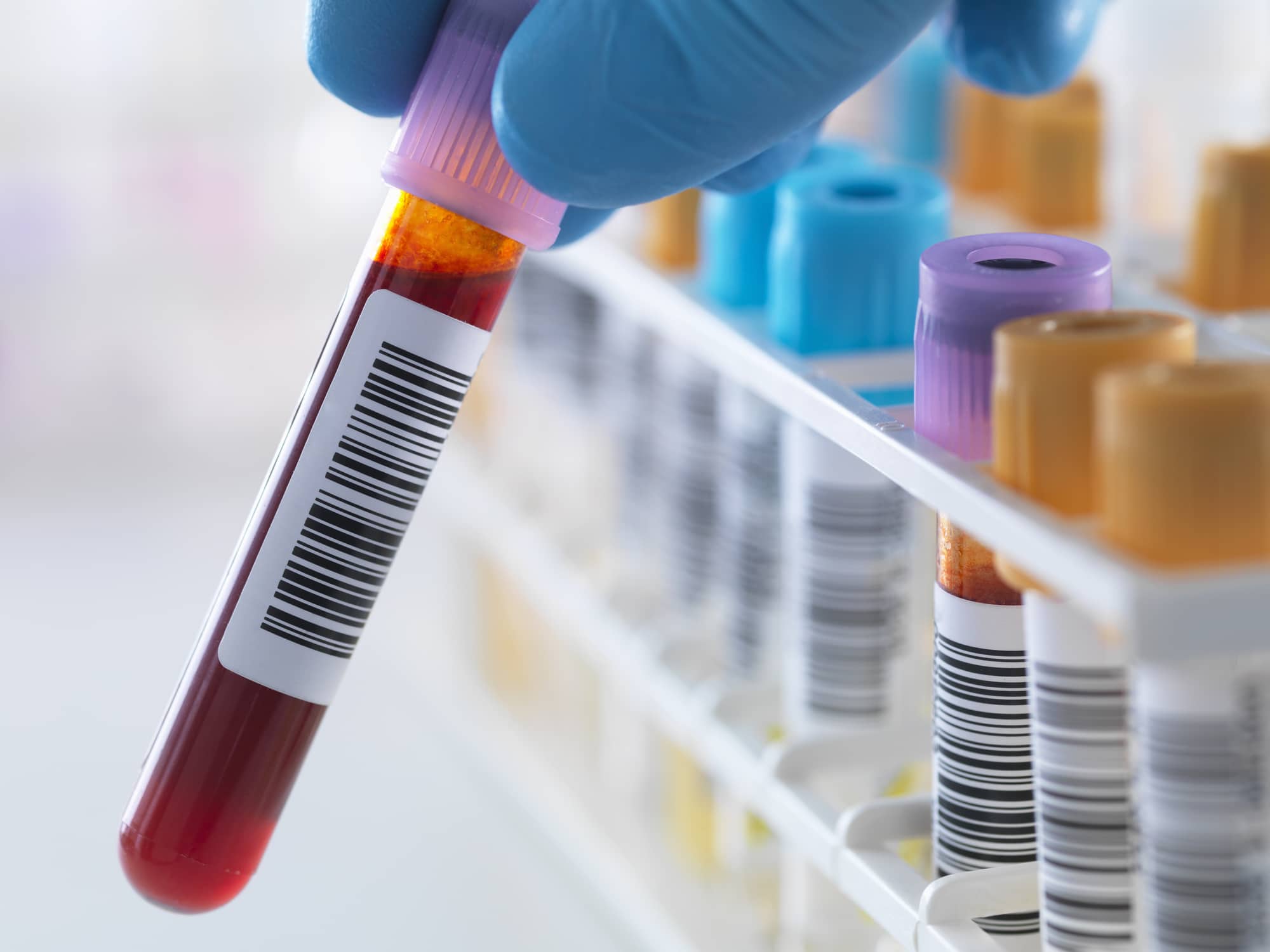 El análisis de sangre que detecta tumores y dónde se encuentran