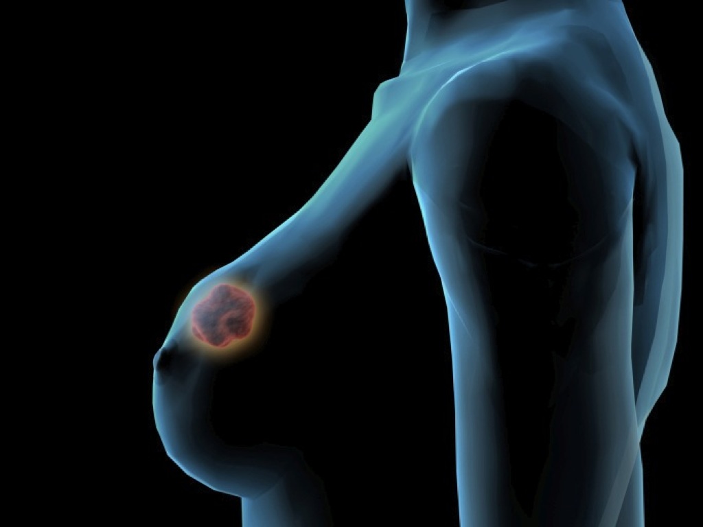 “El cáncer de mama sólo es hereditario en un 5-10%”