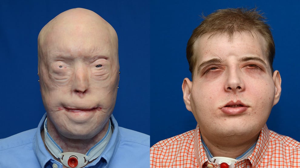 El trasplante de cara más difícil de la historia