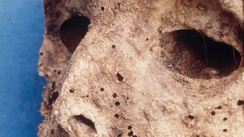 Esta momia del siglo XVI es el caso más antiguo conocido de hepatitis B