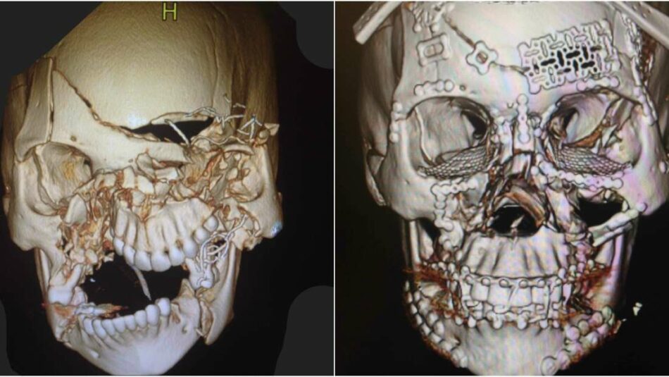 Impresionante imagen de un cráneo tras una reconstrucción facial