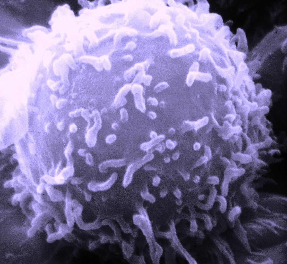 Luchar contra el cáncer con células inmunes de otra persona