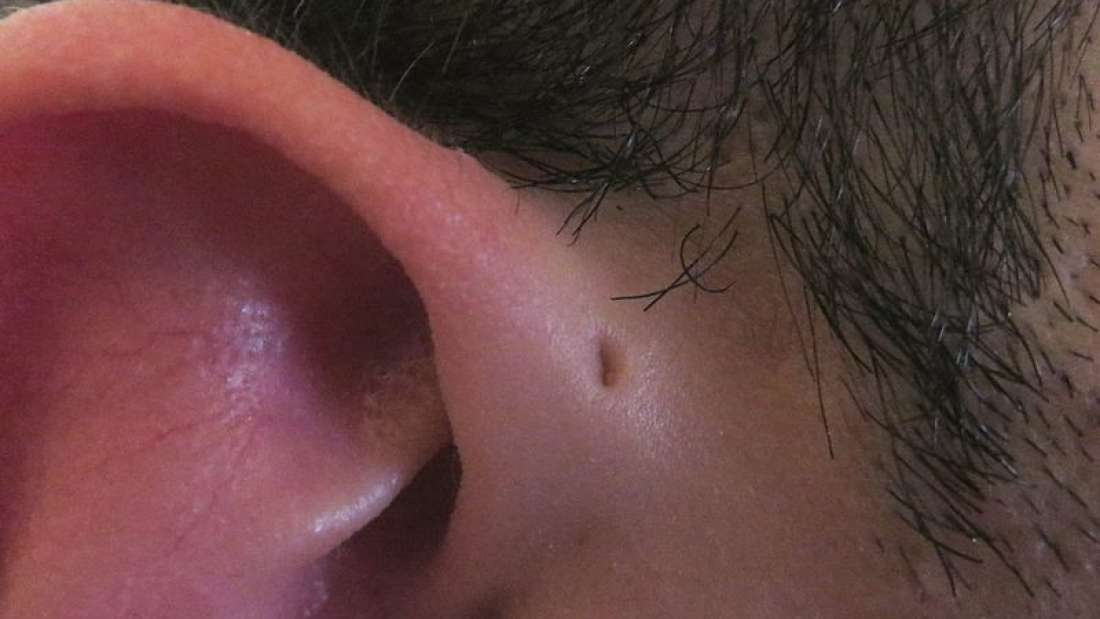 ¿Por qué algunas personas tienen este curioso agujero en sus orejas?