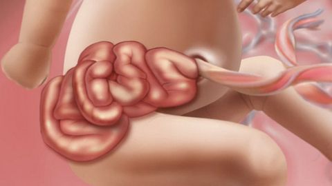 ¿Por qué nacen más bebés con los intestinos fuera?