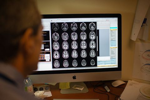Escáner para predecir la demencia