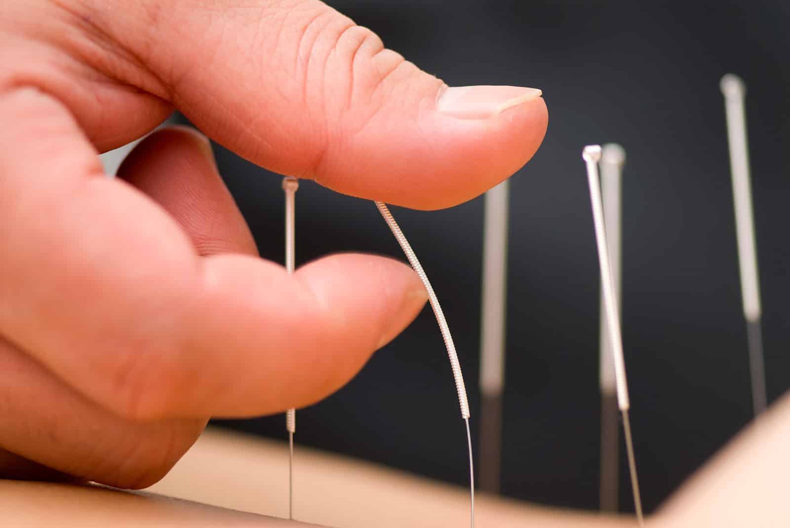 Un estudio menciona los beneficios de la acupuntura en la fibromialgia