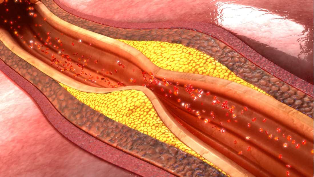 Un fármaco contra el cáncer puede derretir la grasa de las arterias
