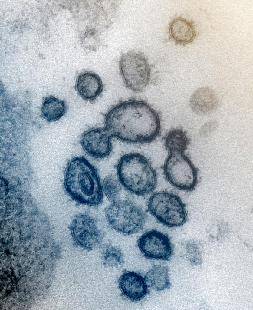 Fotografía con microscopio electrónico del coronavirus SARS-CoV-2 