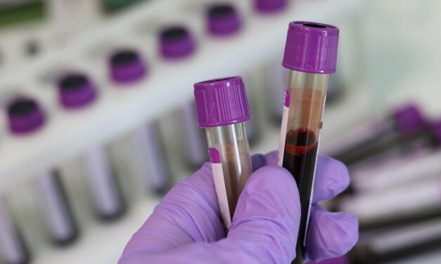 Un análisis de sangre puede detectar el cáncer con cuatro años de adelanto