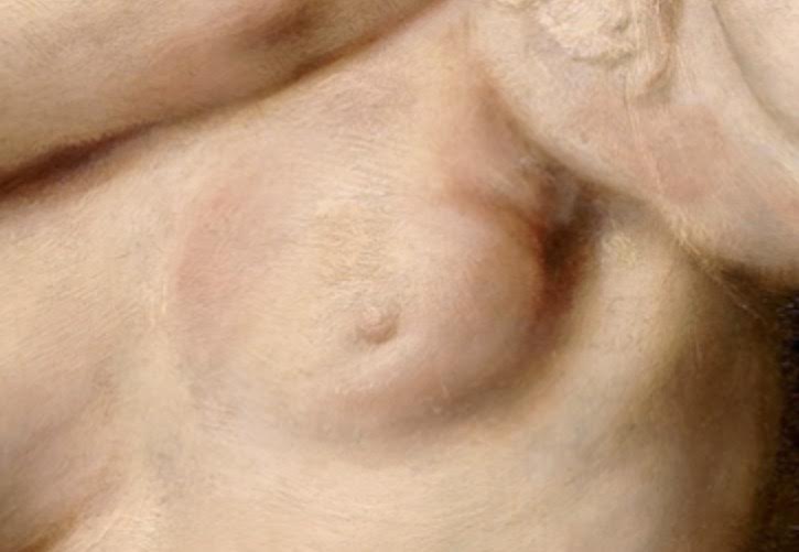 Detalle de la mama que muestra la lesión