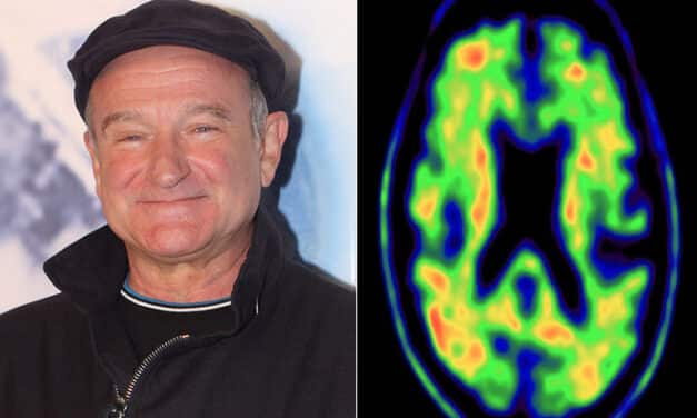 La rara demencia por la que se suicidó Robin Williams ahora puede detectarse en un cerebro vivo