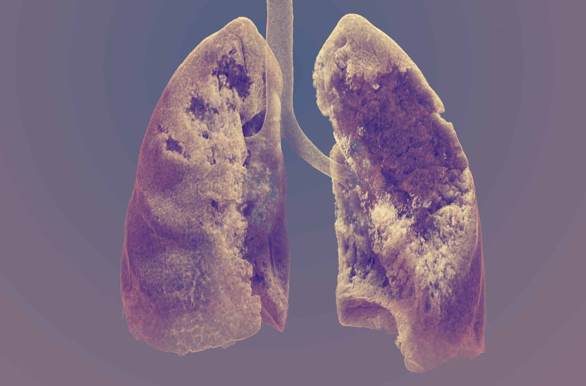 Un pulmón tras la Covid-19 gana un concurso de fotografía científica