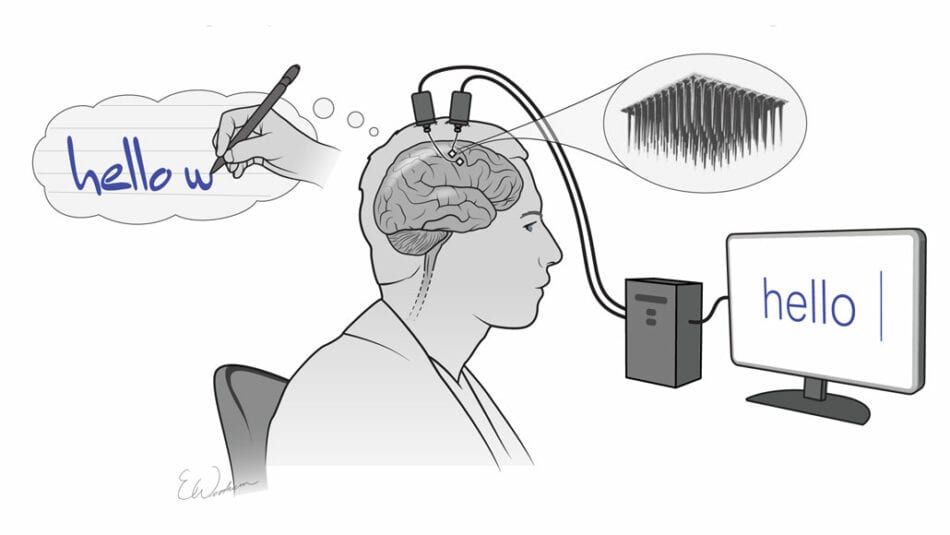 Un implante cerebral permite por primera vez escribir con el pensamiento