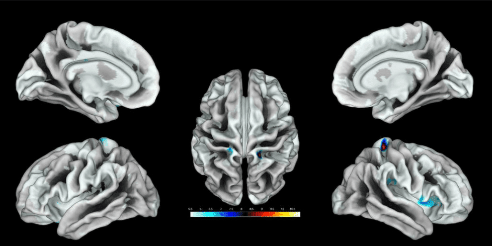 Ubicación de la región del cerebro activada por estimulación del clítoris en un grupo de mujeres. / Knop et al., JNeurosci 2021
