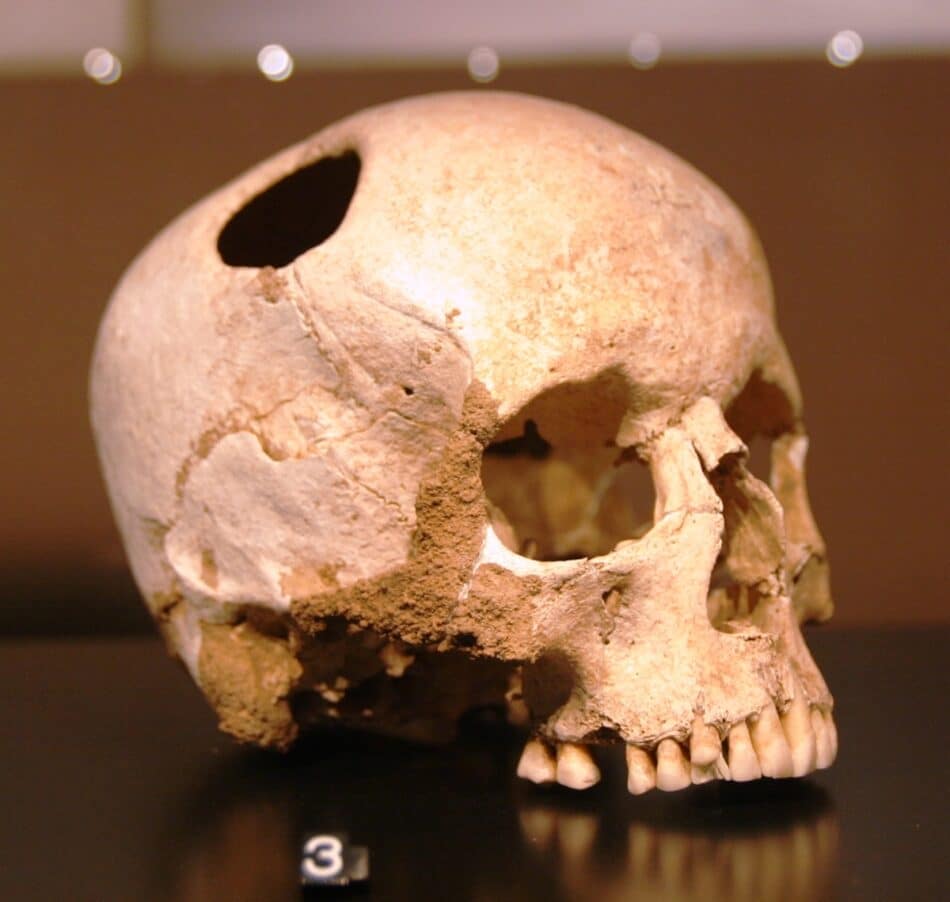 La cirugía cerebral que los humanos practicaban hace 5.000 años
