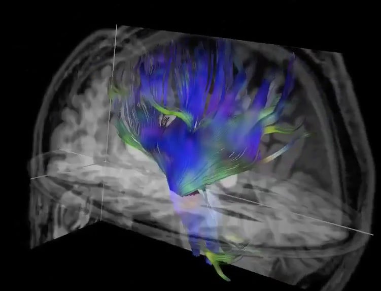 Imágenes con tensor de difusión, una técnica de IRM, del cerebro.