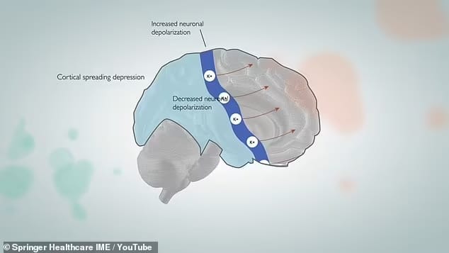 Antes de que algunas personas sientan una migraña, su visión se interrumpe. Esto ocurre cuando una oleada de señales se dispara a través del cerebro, como en el diagrama de la imagen. Con estas señales, un fluido que transporta proteínas causantes de la migraña es expulsado del cerebro y se dirige a los receptores del dolor.