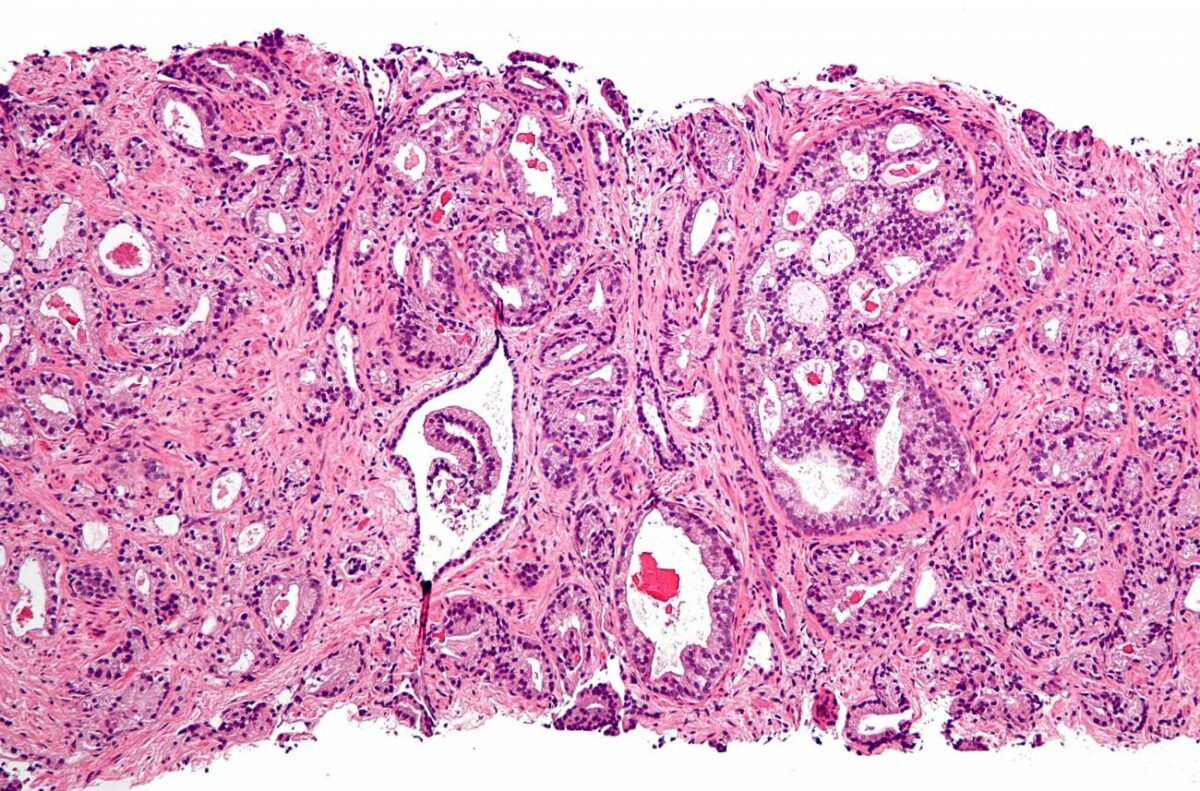 Cuidar la dieta puede evitar que progrese el cáncer de próstata a estados más peligrosos