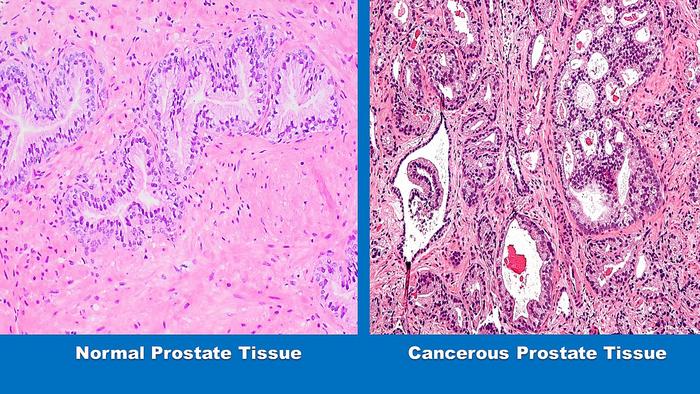 Microfotografías que comparan el tejido prostático normal con el canceroso. Un nuevo estudio, dirigido por Johns Hopkins Medicine, demuestra -por lo que se cree que es la primera vez- que una dieta sana puede ayudar a evitar que el cáncer de próstata de bajo grado evolucione a una enfermedad más agresiva. Crédito: Gráfico creado por M.E. Newman, Johns Hopkins Medicine, a partir de imágenes de dominio públicoMicrofotografías que comparan el tejido prostático normal con el canceroso. Un nuevo estudio, dirigido por Johns Hopkins Medicine, demuestra -por lo que se cree que es la primera vez- que una dieta sana puede ayudar a evitar que el cáncer de próstata de bajo grado evolucione a una enfermedad más agresiva. Crédito: Gráfico creado por M.E. Newman, Johns Hopkins Medicine, a partir de imágenes de dominio público