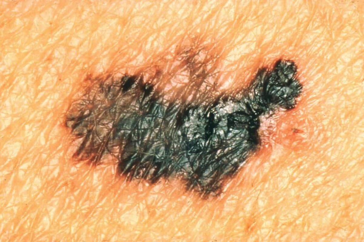 El cáncer de piel utiliza este truco para inutilizar tu sistema inmunitario