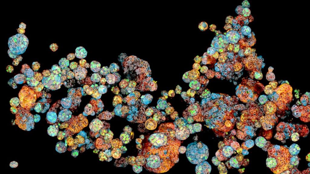 Organoides de cáncer de mama