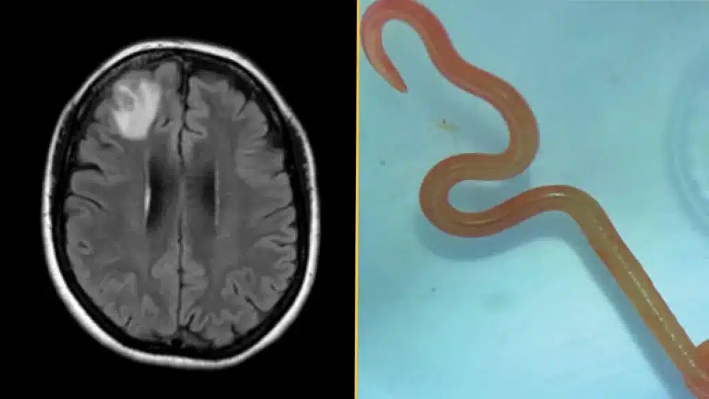 Una mujer tenía un gusano en el cerebro nunca antes encontrado en humanos 1 gusano en el cerebro