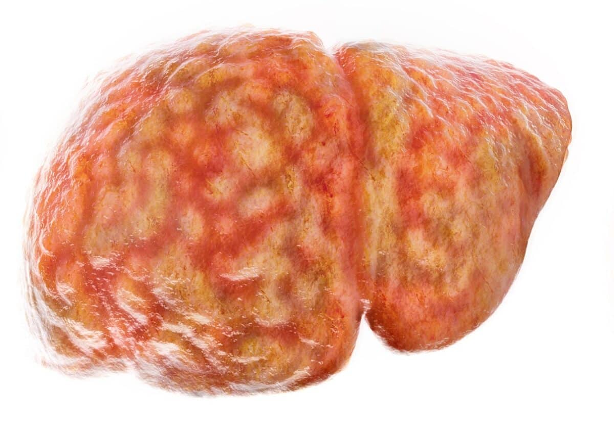 Dos fármacos que ya existen podrían revertir el hígado graso, según investigadores de Barcelona