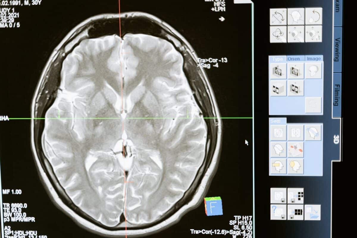 Inesperado: la testosterona no acelera el tumor cerebral más mortal en hombres, sino que lo puede frenar