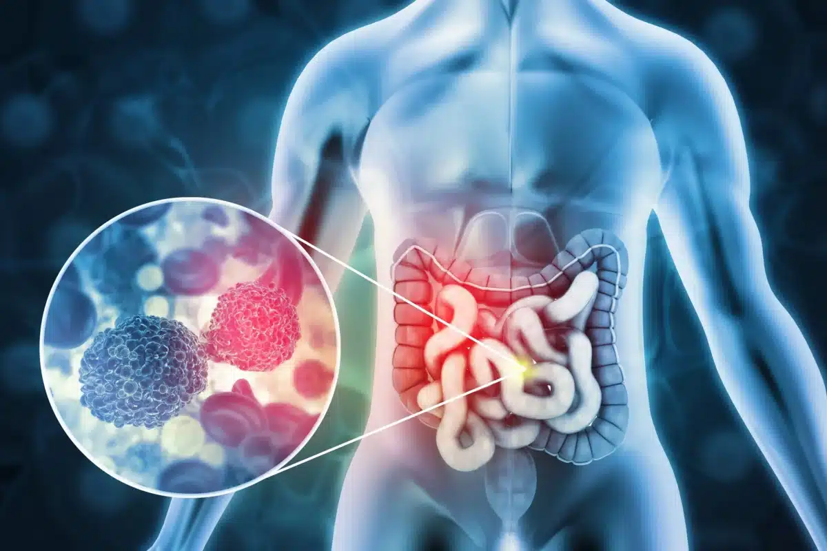 El cáncer de colon, las bacterias del intestino y la fibra que comemos