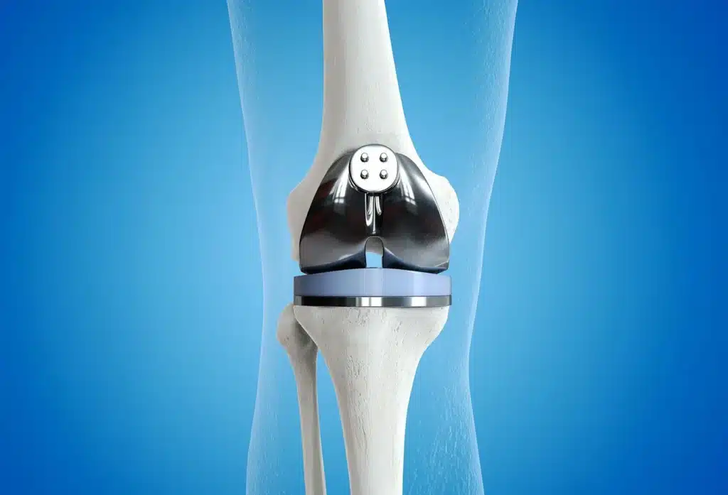 ¿Adiós a las prótesis de rodilla? Es posible hacer creer el cartílago de nuevo sin células madre 1 prótesis de rodilla